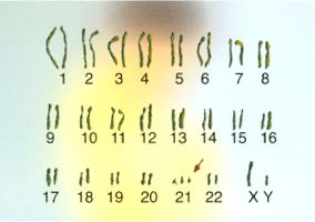 细胞遗传表现为第21号染色体多了一条来自母亲的染色体
