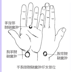 腱鞘囊肿概述