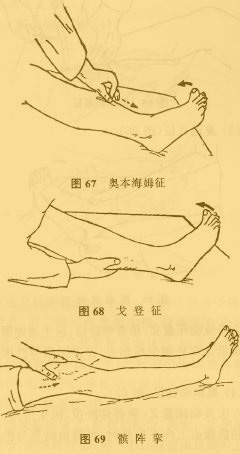 医生用钝器从患者外踝沿足背外侧向前划去,得出结果与巴彬斯基征同