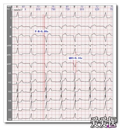山羊老师课程常见心电图诊断知识讲座第二十四讲 预激综合征