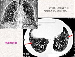 间质性肺炎症状有哪些 (转载)