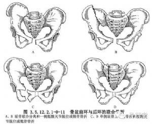 最详细的骶髂关节错位的诊断与复位