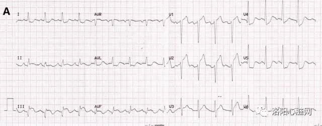【心电学】赵运涛:应激性心肌病心电图的再认识