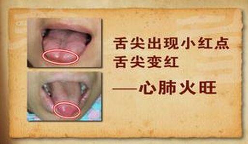 中医养生:舌苔溃烂,舌上无苔,舌裂,以及胃热,宿食积滞的关注