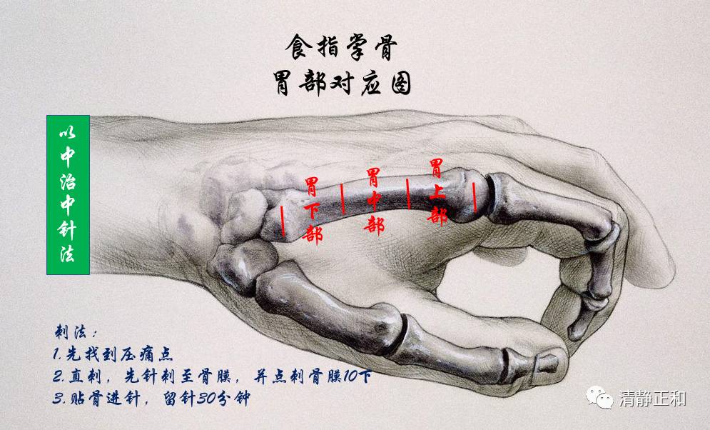 阴阳九针之( )针法个人经验