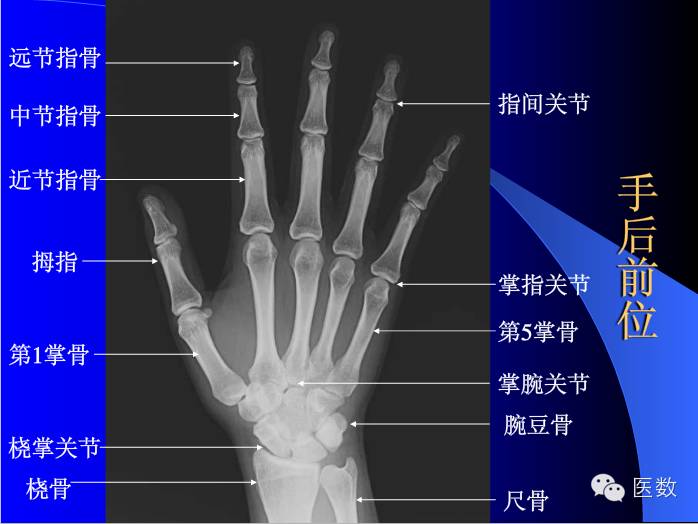 五分钟读图 正常骨骼不同体位x光片解读及常见骨折高精图谱