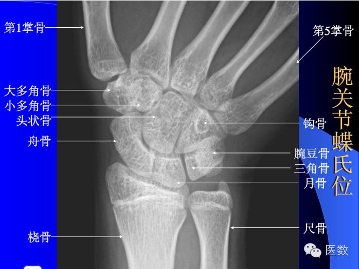五分钟读图 正常骨骼不同体位x光片解读及常见骨折高精图谱