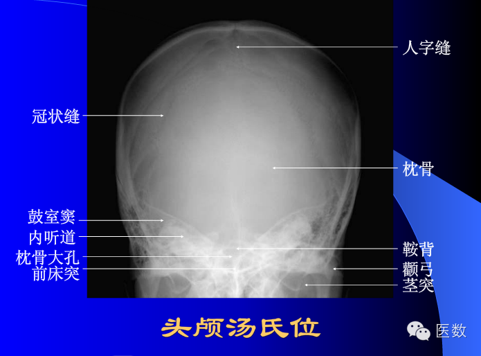 五分钟读图 正常骨骼不同体位x光片解读及常见骨折高精图谱