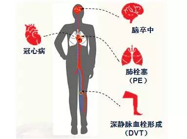 我们总说血栓,那血栓到底是什么?