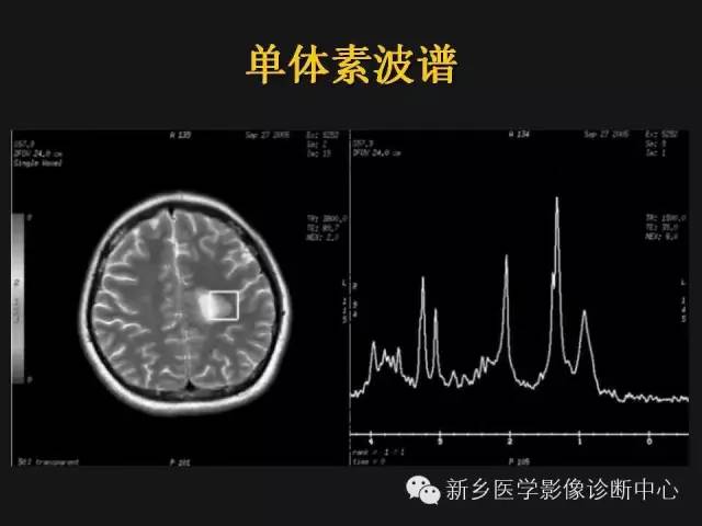 完美的磁共振波谱(mrs)技术详解