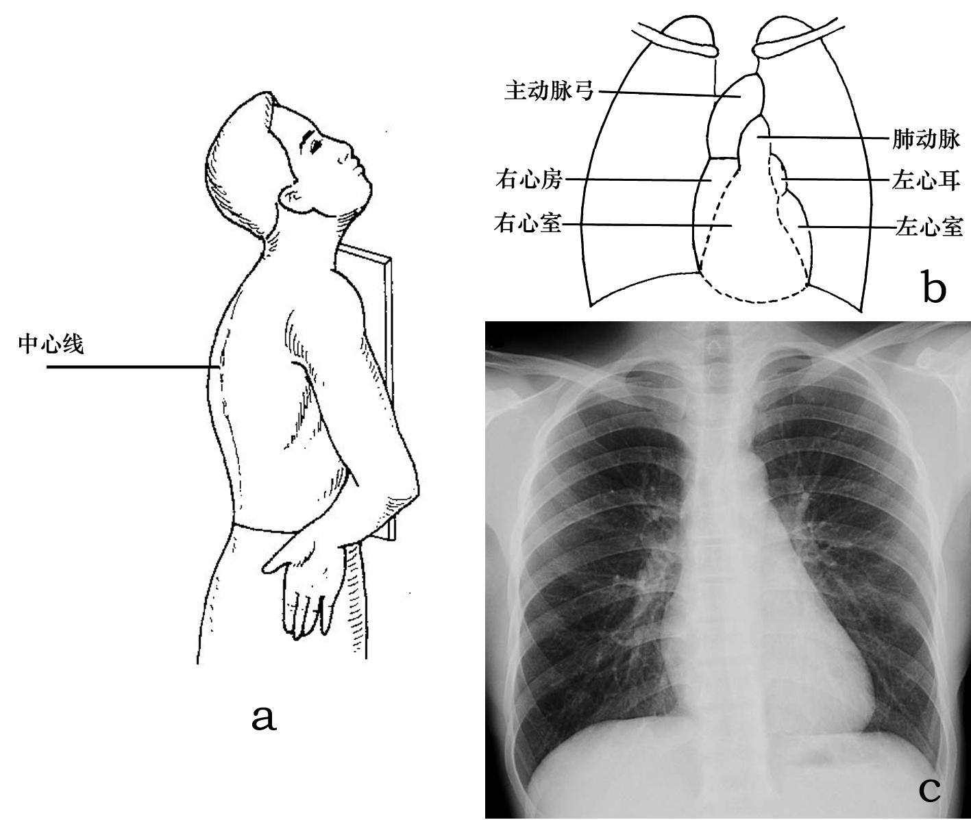 胸部x线摄影体位及临床意义 (转载)