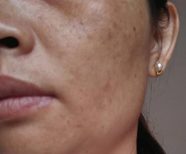 "内失调型黄褐斑"治愈案例,皮肤疾病研究者说出2个淡