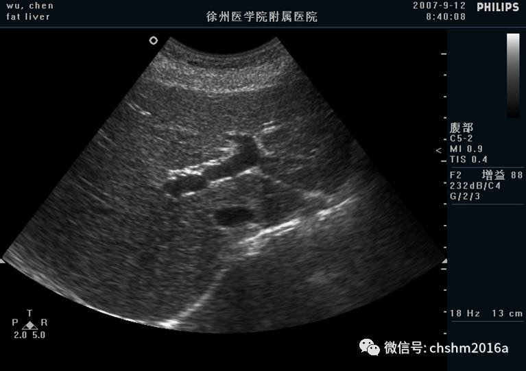 肝脏各径线正常测值