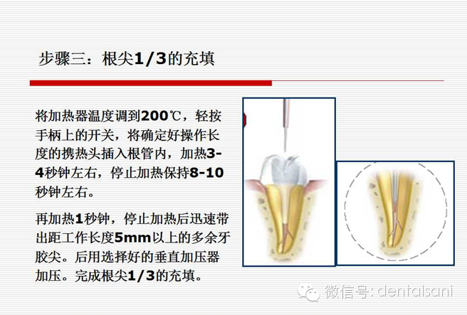 热牙胶根管充填技术及护理