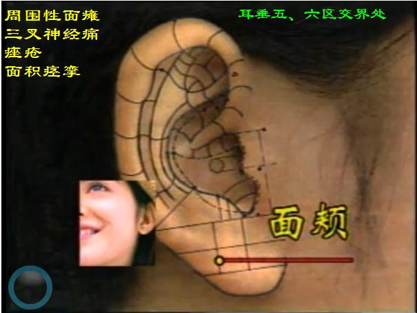 耳穴详解(真人耳穴图片)