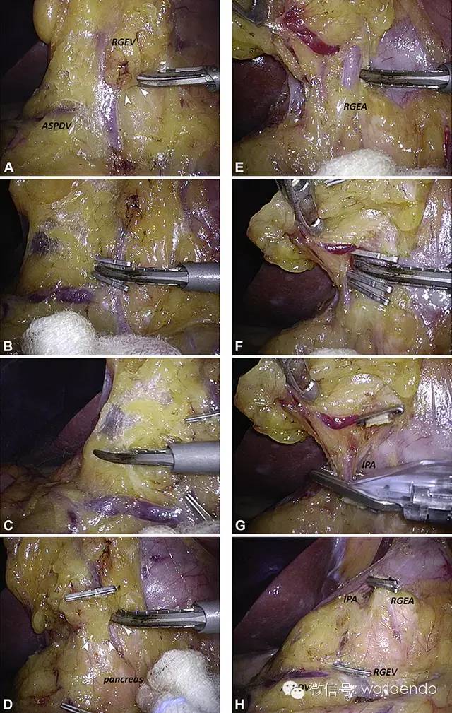 分离层面:腹腔镜胃癌幽门下区淋巴结清扫新方法 (转载)