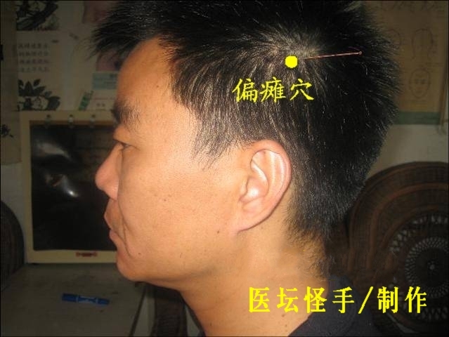 王文远平衡针灸穴位图共38穴