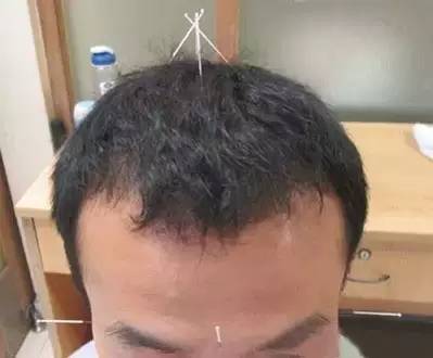 图解针灸三针30组穴位