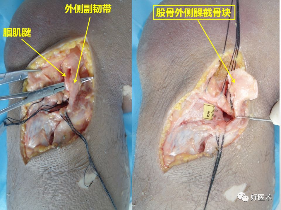 早读| 胫骨平台后外侧骨折手术入路详解!