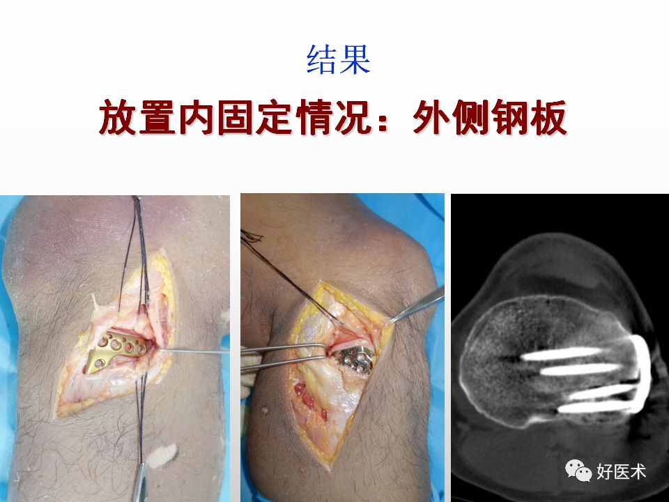 早读| 胫骨平台后外侧骨折手术入路详解!