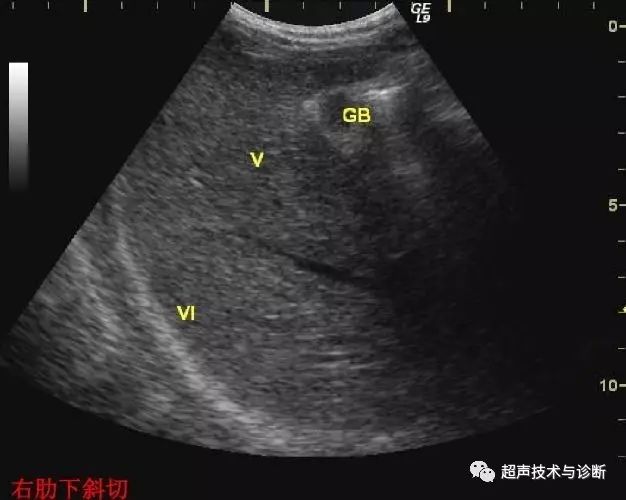 实用肝脏分叶,分段及超声对比图