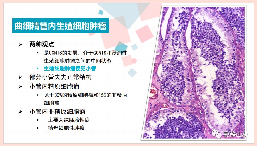 gaowan精原细胞瘤的病理学诊断