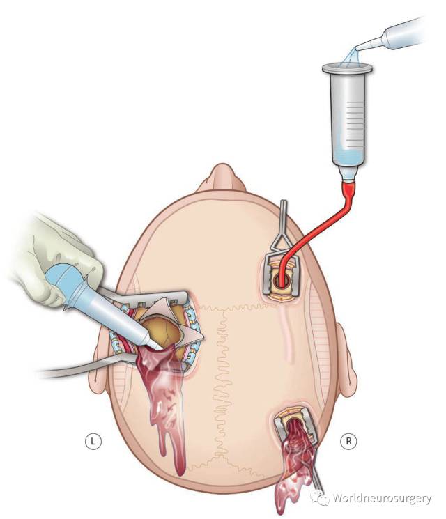 如果硬膜下腔没有被大脑填满,可在直视下置入一根纤细的红色橡皮导管