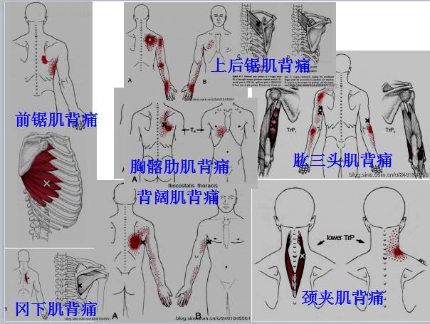 全身激痛点