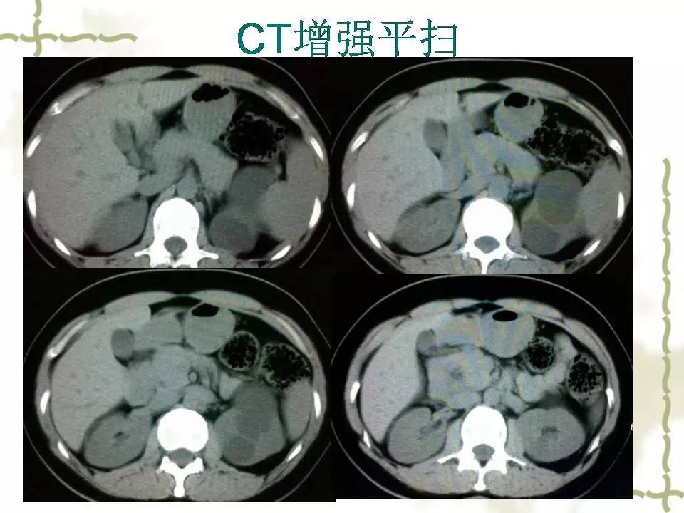 全腹软,右下腹可扪及韧性包块,深压痛,无反跳痛及肌紧张,murphy征阴性