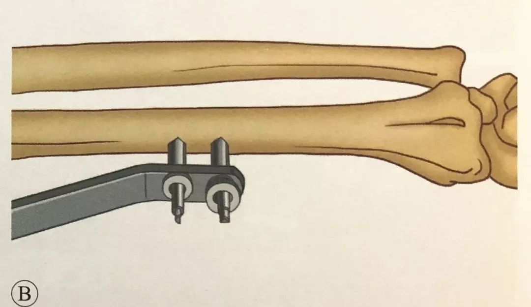 桡骨远端骨折的外固定架固定术