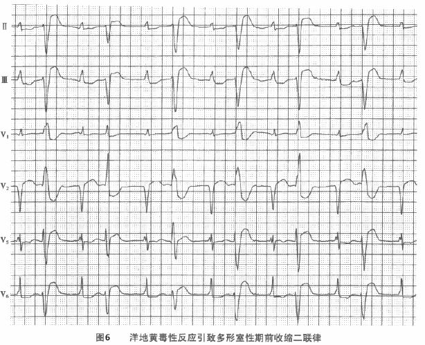 图6为洋地黄中毒引起的多形室性期前收缩二联律.