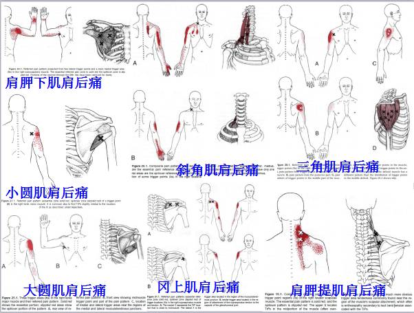 肌筋膜疼痛触发点全身分布图(头颈肩腰腿痛)