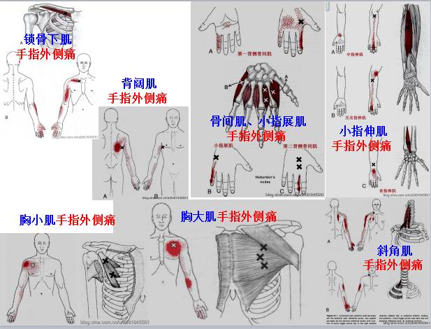 七,腰部   腰   痛  主要激痛点   胸骼肋