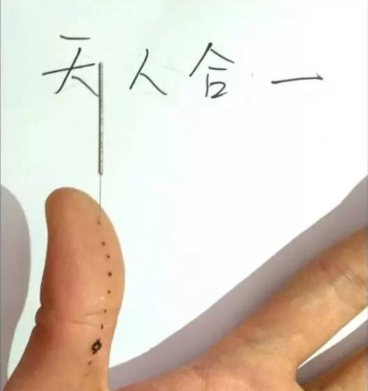 【带图】阴阳九针全息针法详解