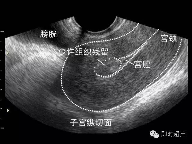 少许绒毛组织残留声像