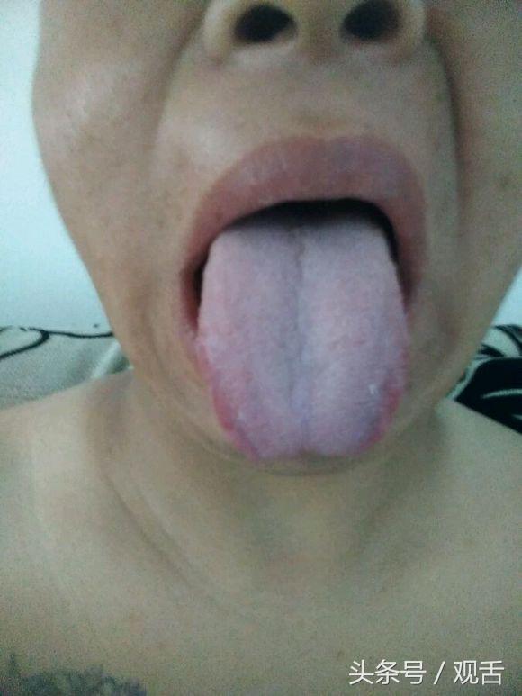 舌诊:脾胃寒湿,阴虚血瘀,肝肾亏虚,脾肾阳虚的舌照!