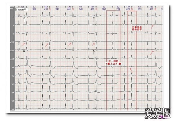 我习惯使用6导联同步编排记录心电图,而且肢导联与胸导联不同步排列