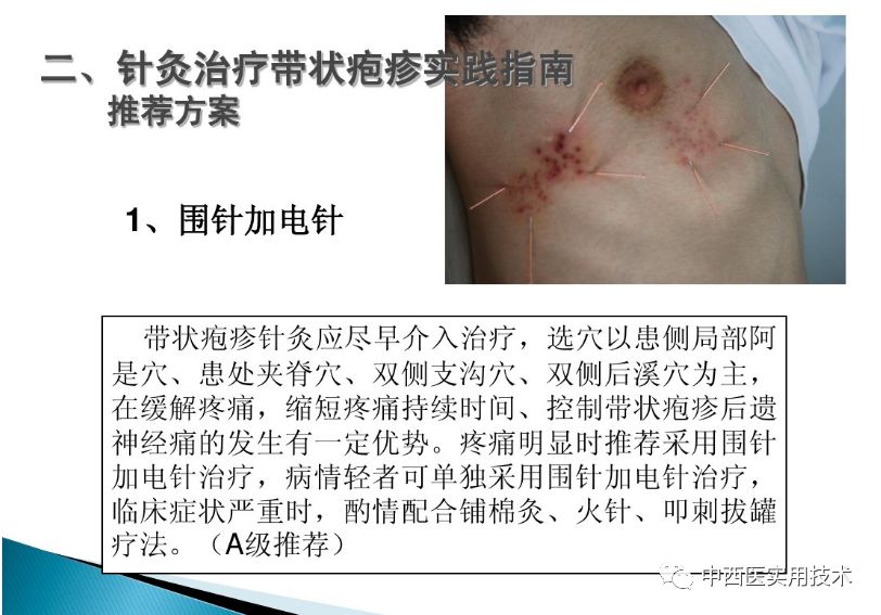 带状疱疹的针灸治疗