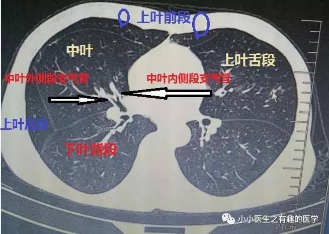 胸部ct解剖入门技巧轻松掌握肺段分布及重要血管