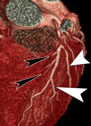 冠状动脉解剖
