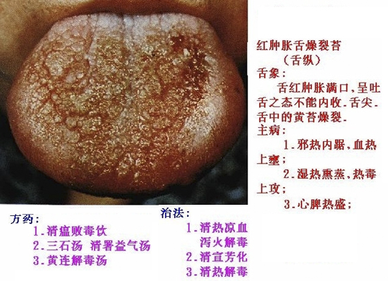 舌象治法方药必须收藏