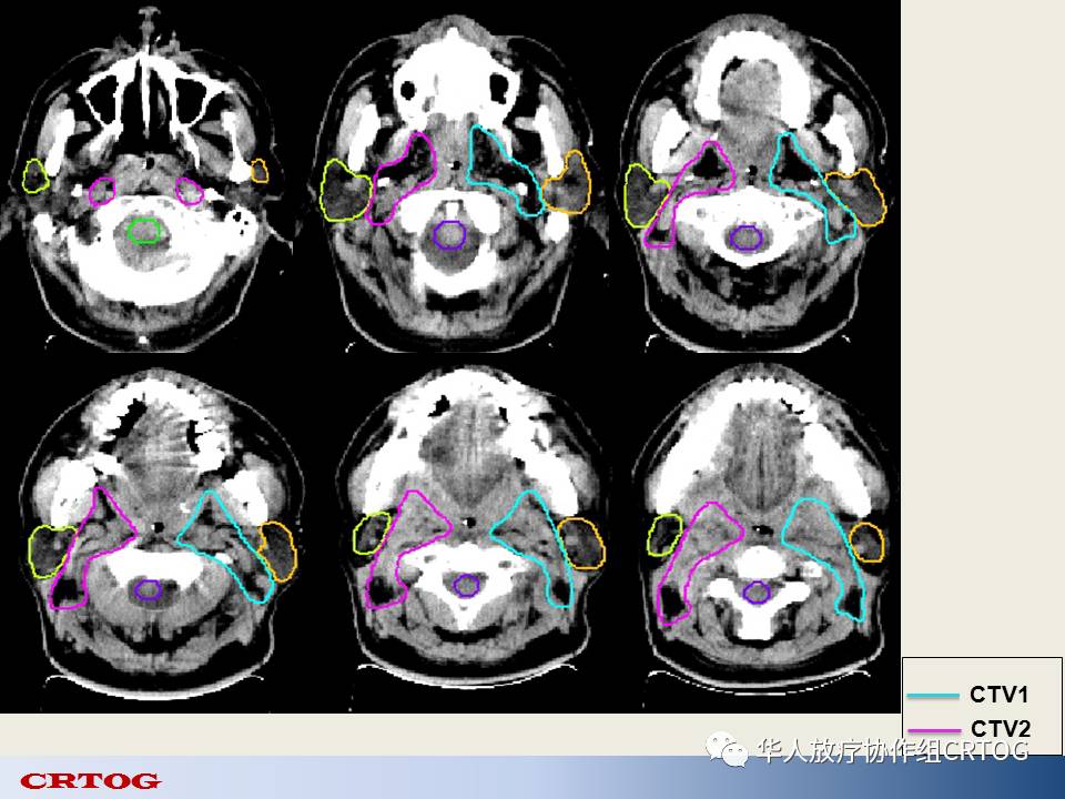 下咽癌精准放疗靶区勾画图谱