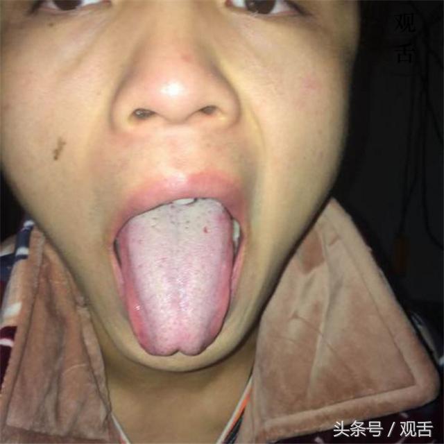舌诊脾胃湿寒脾阳虚热胃阴不足肝脾不和的舌照