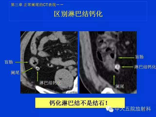 【经典之作】正常阑尾和阑尾炎的ct表现