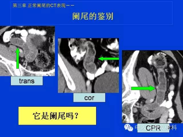 【经典之作】正常阑尾和阑尾炎的ct表现