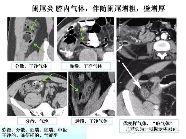 【经典之作】正常阑尾和阑尾炎的ct表现