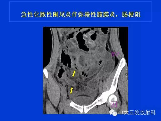 【经典之作】正常阑尾和阑尾炎的ct表现