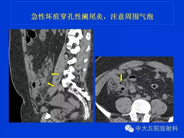 【经典之作】正常阑尾和阑尾炎的ct表现