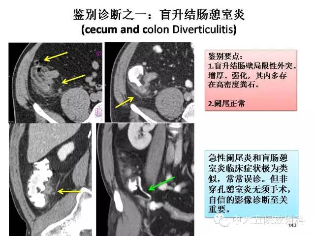 【经典之作】正常阑尾和阑尾炎的ct表现