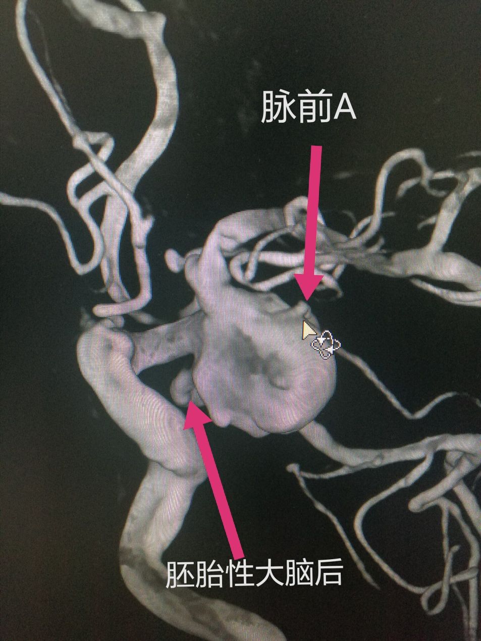 慧眼视介丨神经介入医生的回马枪——微导管成袢技术